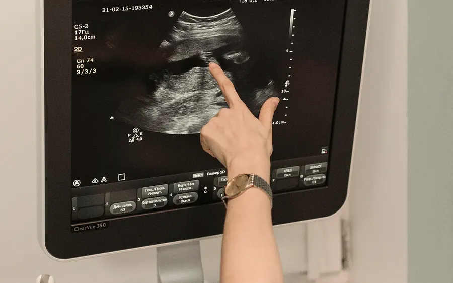Tela do aparelho de ultrassom com a imagem sendo analisada
